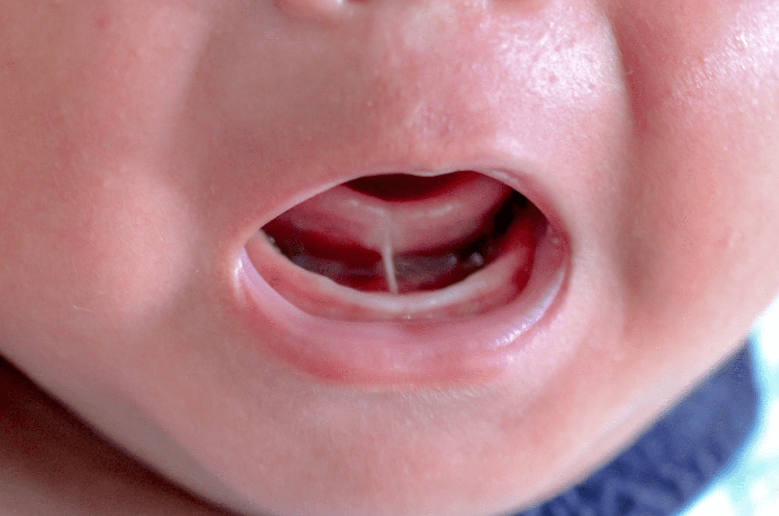 Picture of a tongue tie which makes it hard to  breast feeding